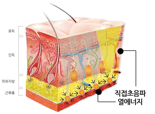 더블로의 치료원리