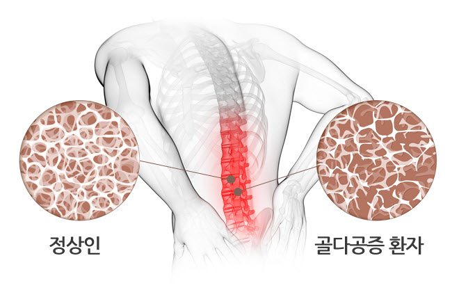 골다공증